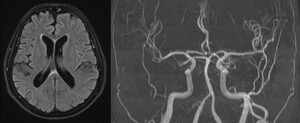 Figure from article: Posterior ischemic optic...