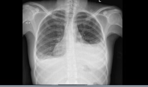 Figure from article: Pleuropericardial effusion...