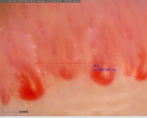 Figure from article: Nailfold capillaroscopy in...
