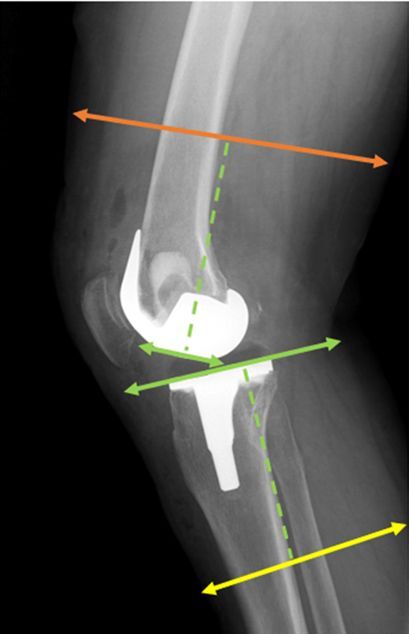 Figure from article: Body mass index and lower...