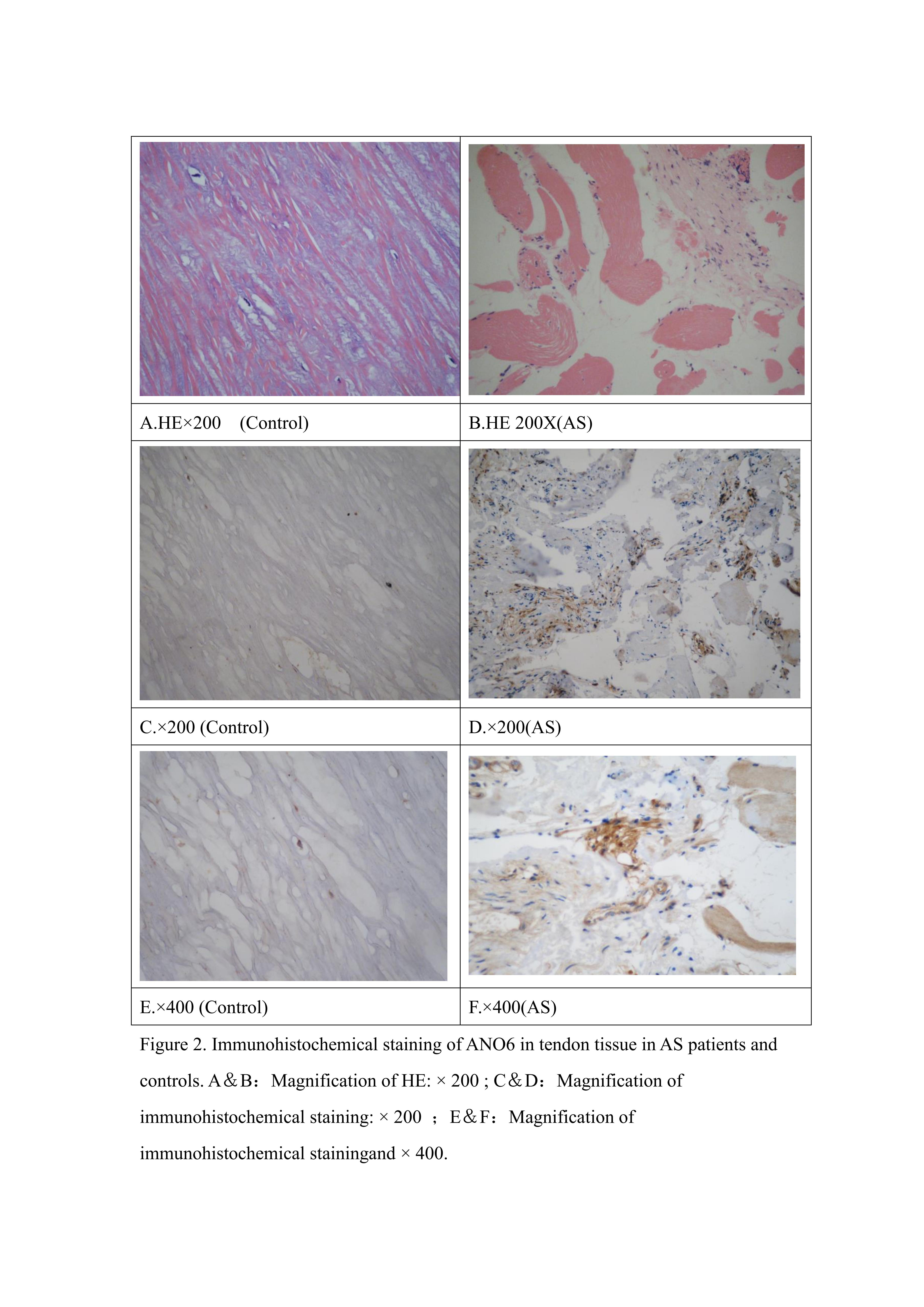 Figure from article: Association of ANO6 gene...