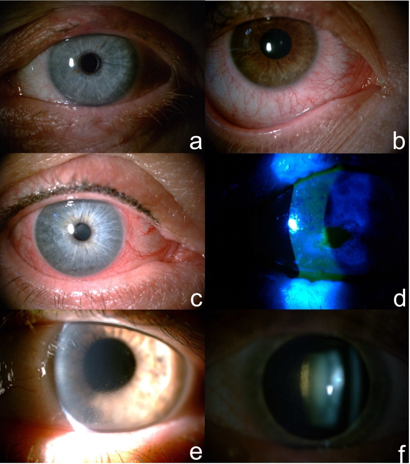Figure from article: Ocular complications in...