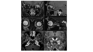 Figure from article: Orbital pseudotumor and...