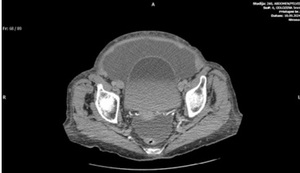 Figure from article: Tjalma syndrome in...