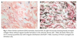 Figure from article: Ehlers-Danlos syndrome and...